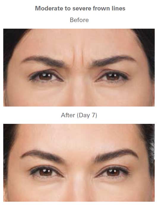 Botox Treatment Before & After Near Me in Midland TX Botox Treatment Before & After Near Me in Midland TX