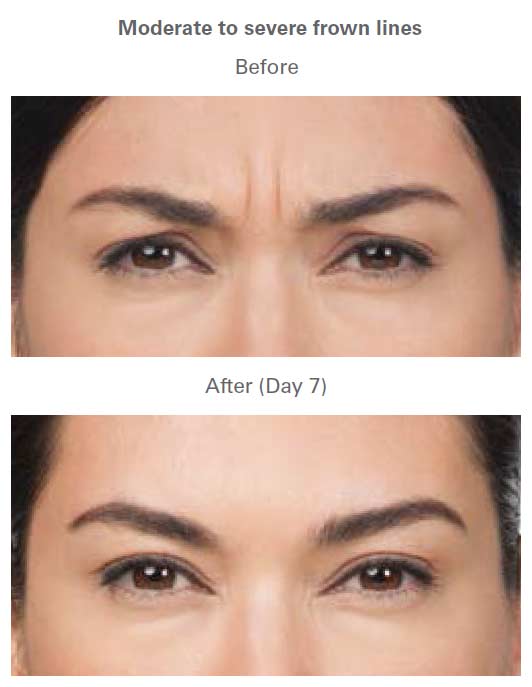 Botox Treatment Before & After Near Me in Midland TX