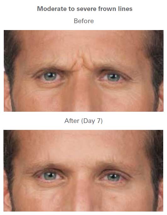 Botox Treatment Before & After Near Me in Midland TX