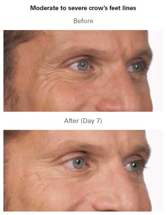 Botox Treatment Before & After Near Me in Midland TX