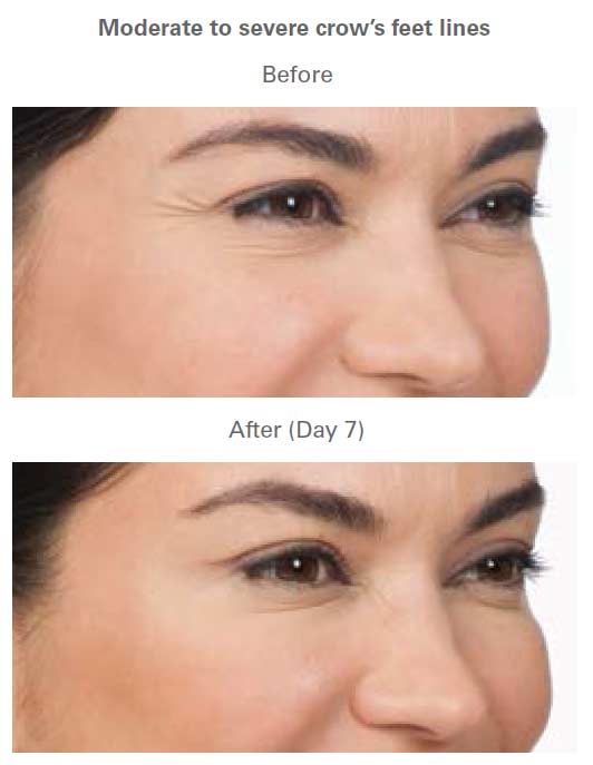 Botox Treatment Before & After Near Me in Midland TX Botox Treatment Before & After Near Me in Midland TX