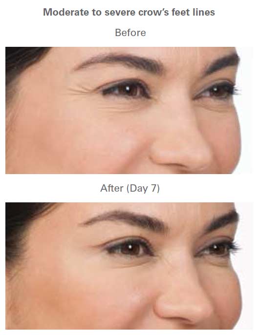 Botox Treatment Before & After Near Me in Midland TX