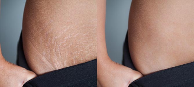 Laser Stretch Marks Removal Specialist Near Me in Midland TX Laser Stretch Marks Removal Specialist Near Me in Midland TX