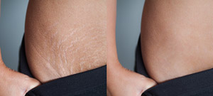 Laser Stretch Marks Removal Specialist Near Me in Midland TX Laser Stretch Marks Removal Specialist Near Me in Midland TX