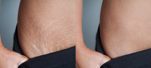 Laser Stretch Marks Removal Specialist Near Me in Midland TX