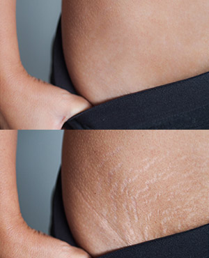 Laser Stretch Marks Removal Near Me in Midland TX