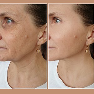 Morpheus8 Before and After Resurfacing for Wrinkles Near Me in Midland TX